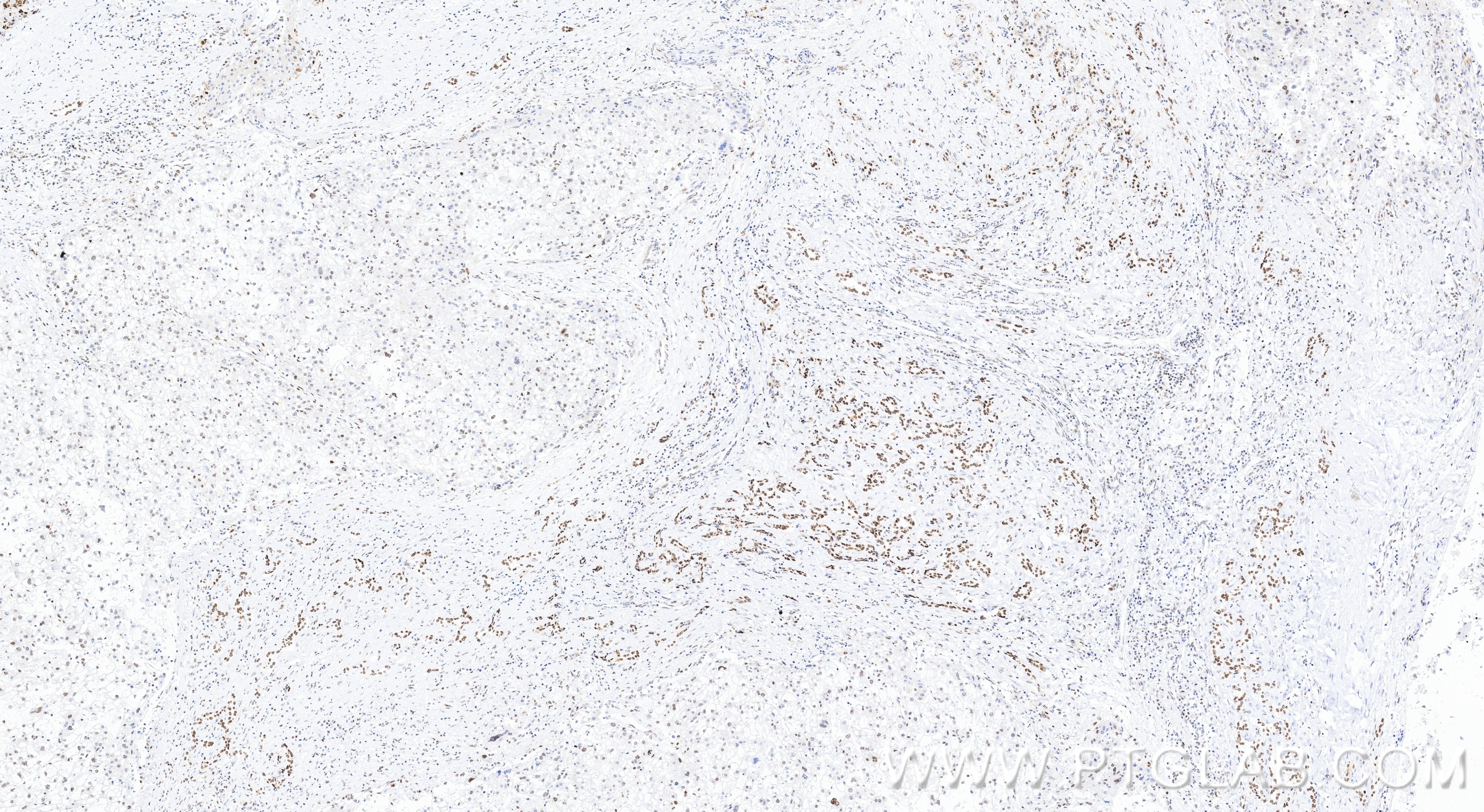 IHC staining of human liver cancer using 86719-1-RR (same clone as 86719-1-PBS) Immunohistochemistry (IHC) staining of human liver cancer tissue using APEX1 Recombinant monoclonal antibody (86719-1-RR)
