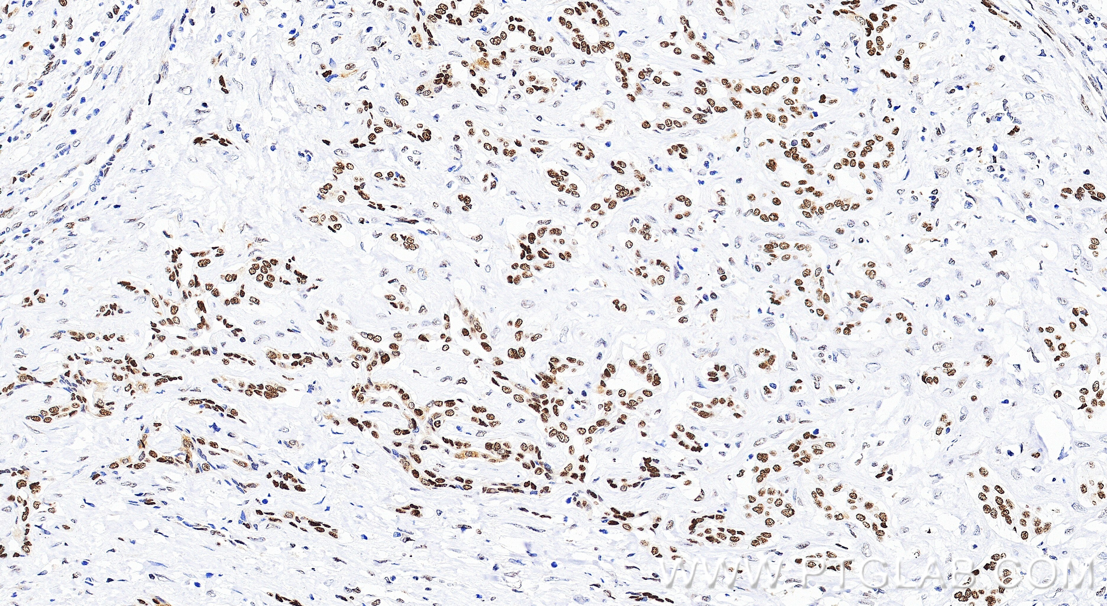 IHC staining of human liver cancer using 86719-1-RR (same clone as 86719-1-PBS) Immunohistochemistry (IHC) staining of human liver cancer tissue using APEX1 Recombinant monoclonal antibody (86719-1-RR)
