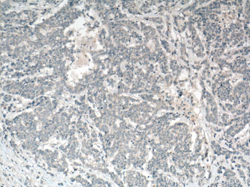 IHC staining of human colon cancer using 11497-1-AP