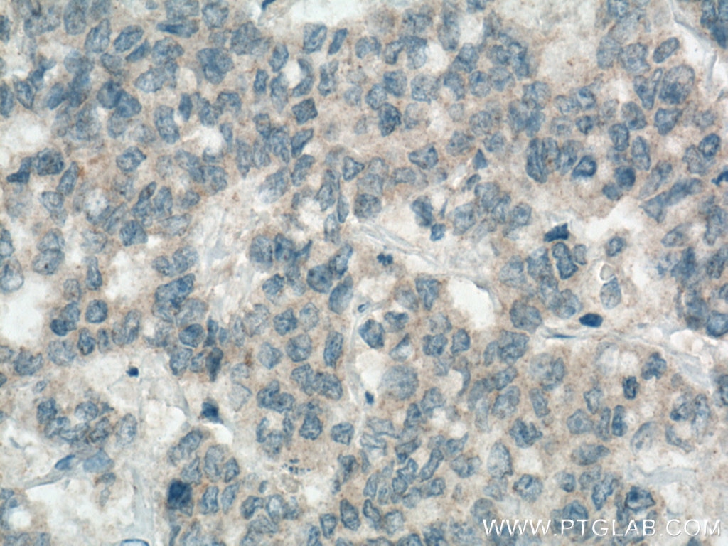 Immunohistochemistry (IHC) staining of human colon cancer tissue using Apelin Polyclonal antibody (11497-1-AP)