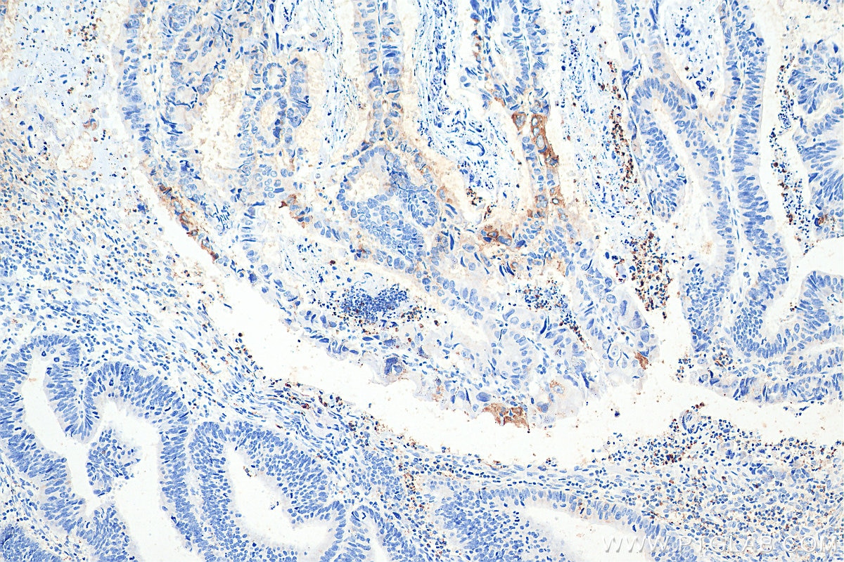 Immunohistochemistry (IHC) staining of human colon cancer tissue using Apelin Polyclonal antibody (11497-1-AP)