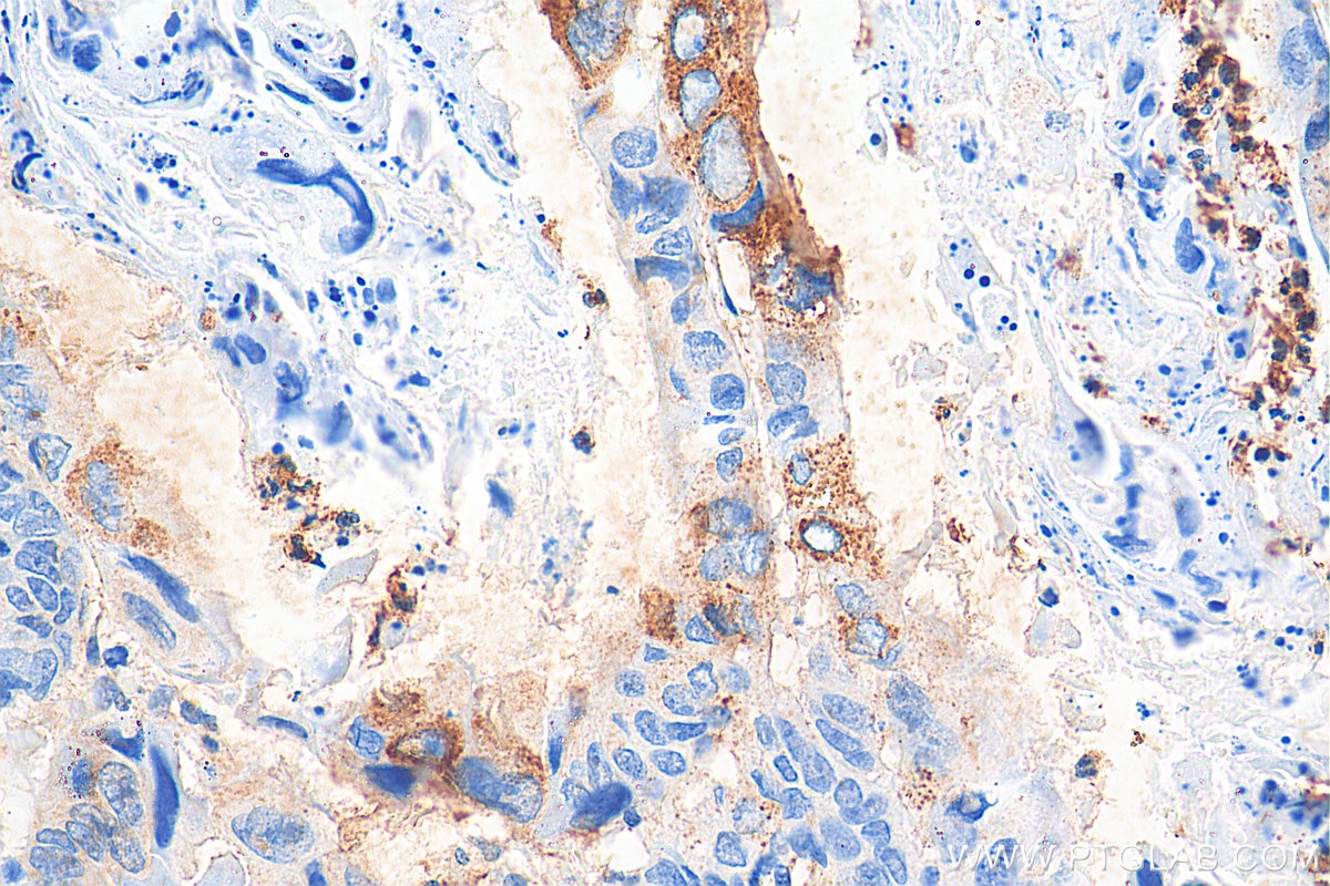 IHC staining of human colon cancer using 11497-1-AP