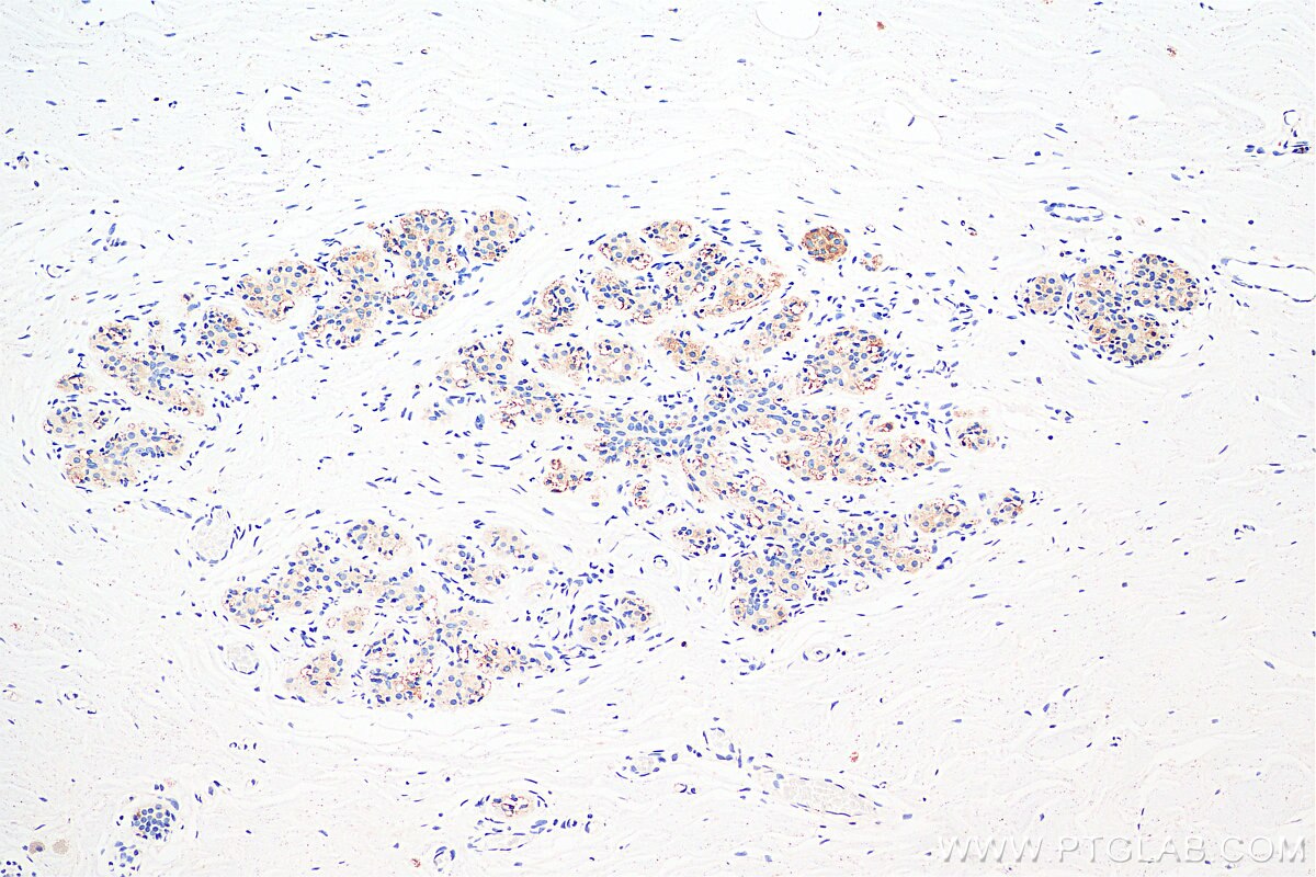 IHC staining of human breast cancer using 11497-1-AP