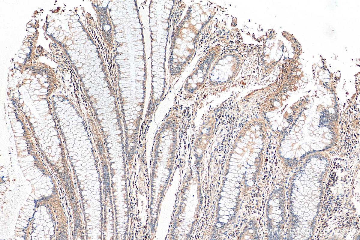 Immunohistochemistry (IHC) staining of human colon cancer tissue using Apelin Polyclonal antibody (11497-1-AP)