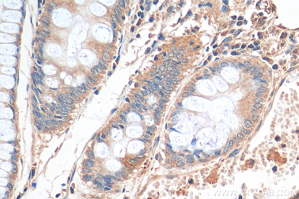 Immunohistochemistry (IHC) staining of human colon cancer tissue using Apelin Polyclonal antibody (11497-1-AP)