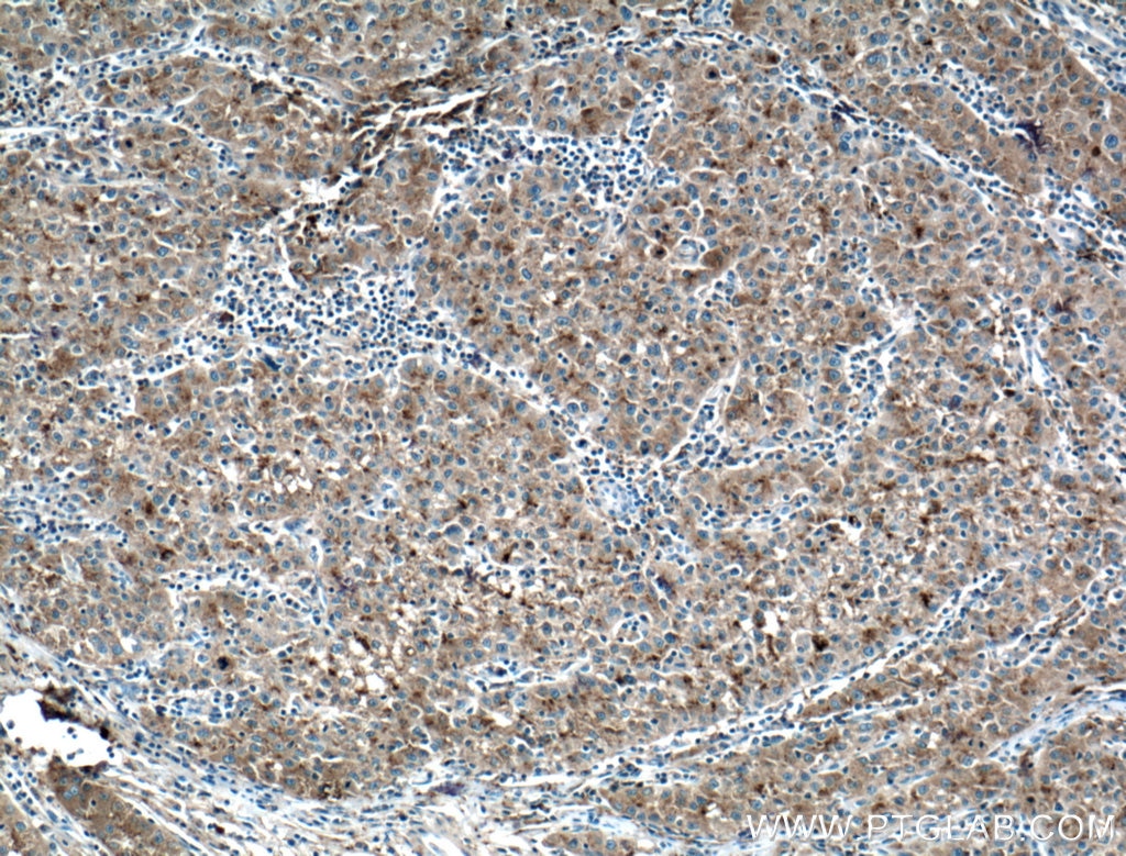 Immunohistochemistry (IHC) staining of human liver cancer tissue using Apolipoprotein AI Polyclonal antibody (14427-1-AP)