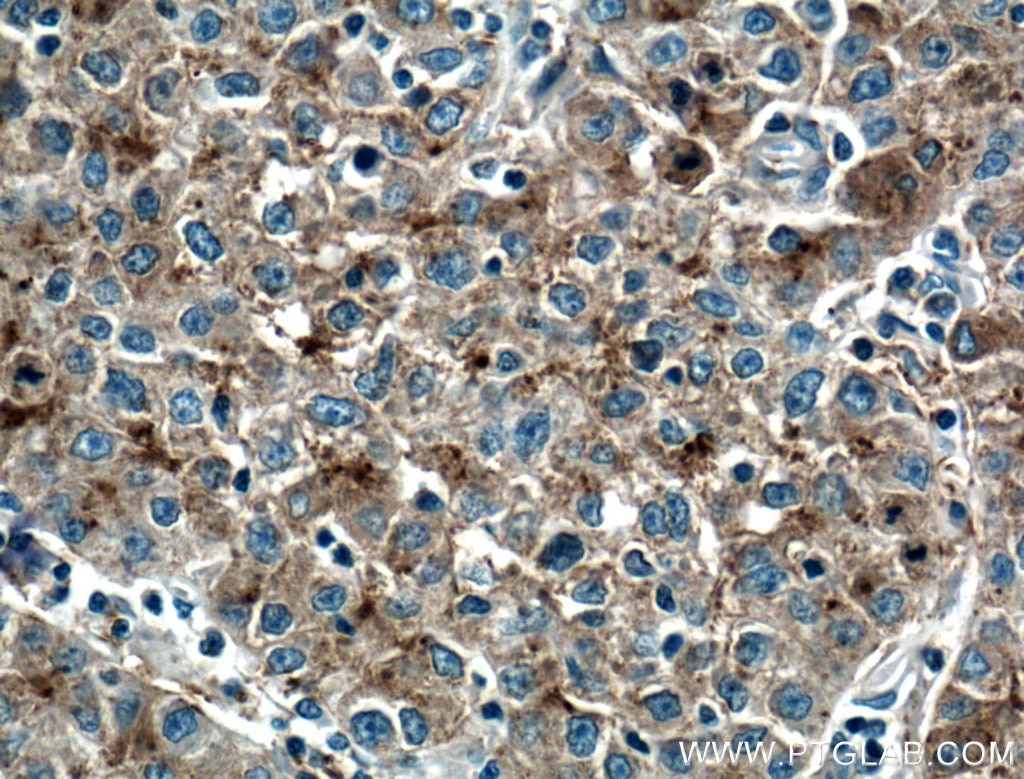 Immunohistochemistry (IHC) staining of human liver cancer tissue using Apolipoprotein AI Polyclonal antibody (14427-1-AP)