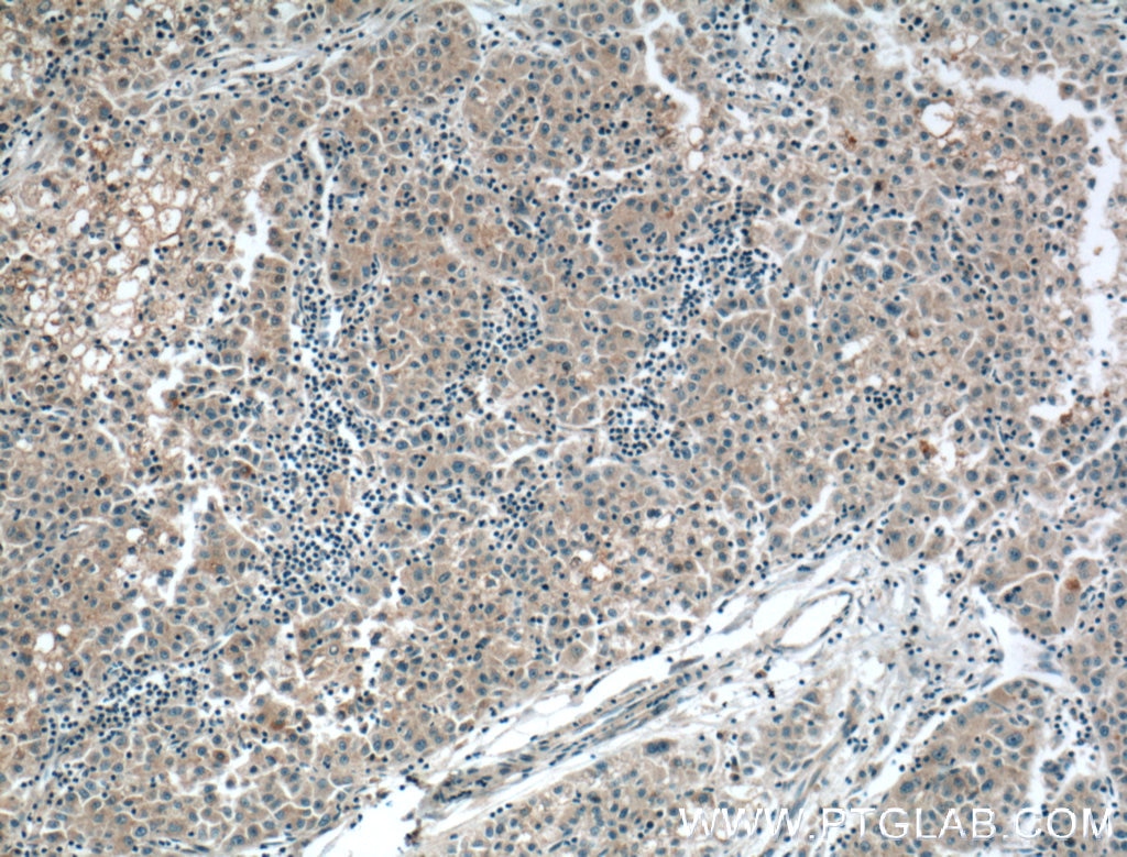 Immunohistochemistry (IHC) staining of human liver cancer tissue using Apolipoprotein AI Monoclonal antibody (66206-1-Ig)