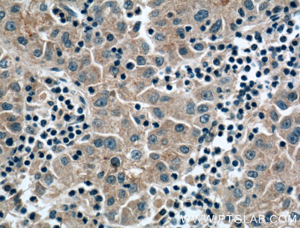 Immunohistochemistry (IHC) staining of human liver cancer tissue using Apolipoprotein AI Monoclonal antibody (66206-1-Ig)
