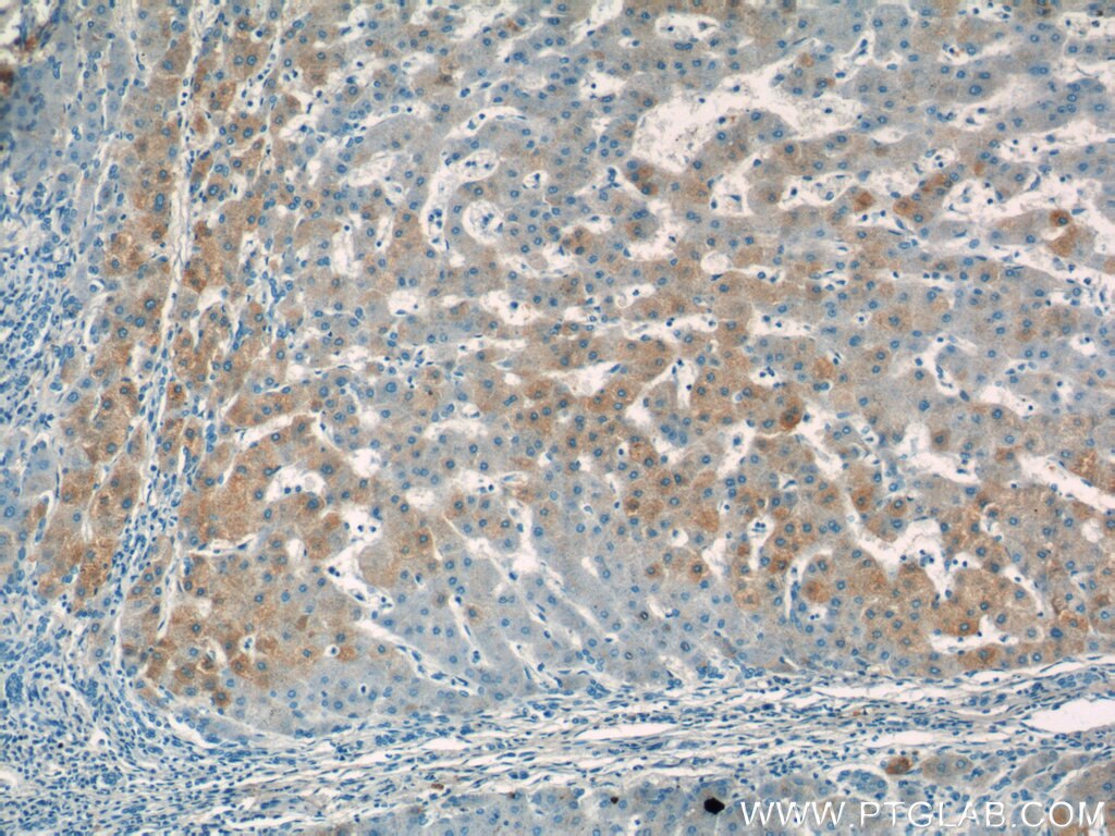 Immunohistochemistry (IHC) staining of human hepatocirrhosis tissue using Apolipoprotein A II Polyclonal antibody (16845-1-AP)