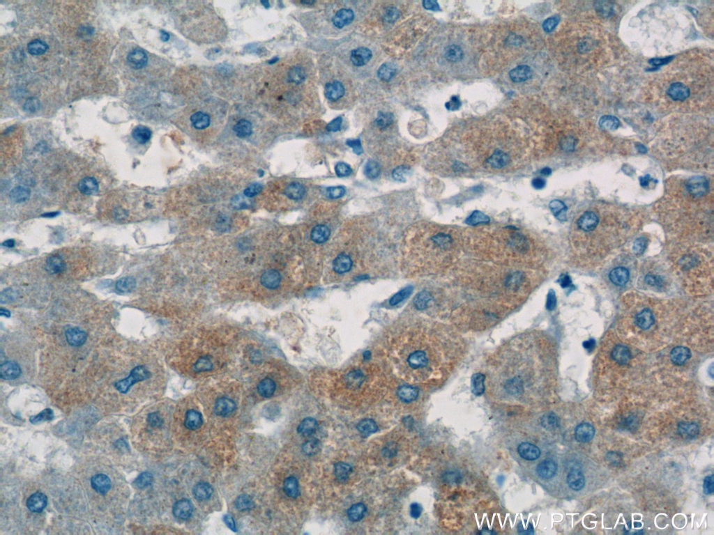 Immunohistochemistry (IHC) staining of human hepatocirrhosis tissue using Apolipoprotein A II Polyclonal antibody (16845-1-AP)