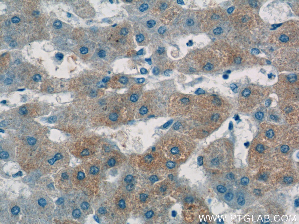 IHC staining of human hepatocirrhosis using 16845-1-AP