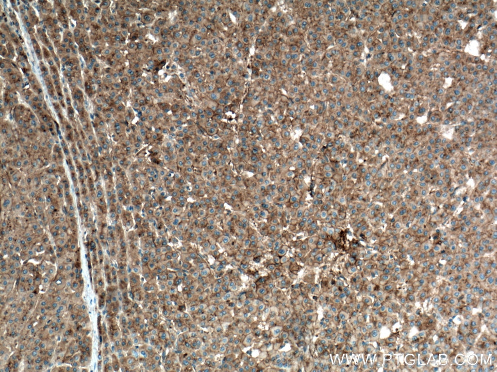 Immunohistochemistry (IHC) staining of human liver cancer tissue using Apolipoprotein A II Monoclonal antibody (66773-1-Ig)