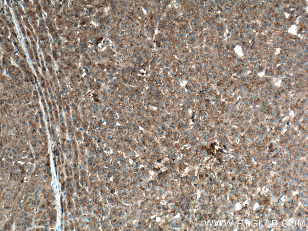 Immunohistochemistry (IHC) staining of human liver cancer tissue using Apolipoprotein A II/APOA2 Monoclonal antibody (66773-1-Ig)