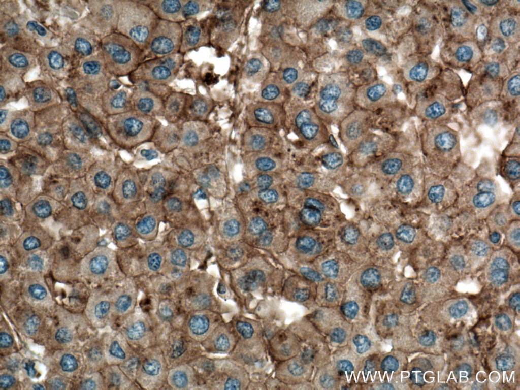 Immunohistochemistry (IHC) staining of human liver cancer tissue using Apolipoprotein A II Monoclonal antibody (66773-1-Ig)