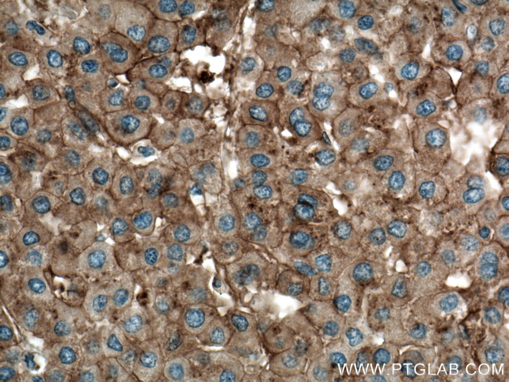 IHC staining of human liver cancer using 66773-1-Ig