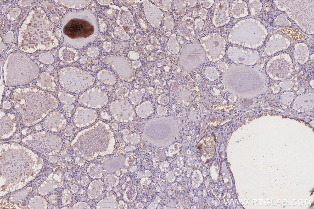 Immunohistochemistry (IHC) staining of human thyroid cancer tissue using APOA4 Monoclonal antibody (66252-1-Ig)