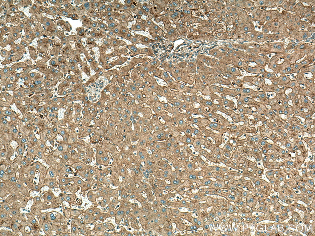 Immunohistochemistry (IHC) staining of human hepatocirrhosis tissue using APOB Polyclonal antibody (20578-1-AP)