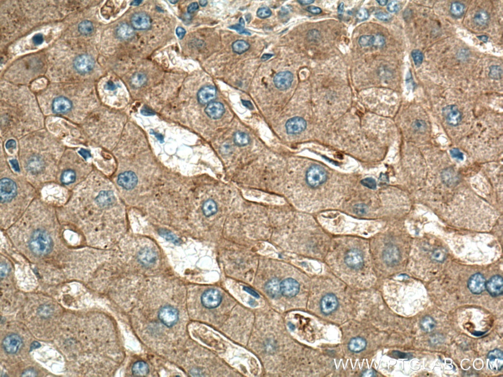 Immunohistochemistry (IHC) staining of human hepatocirrhosis tissue using APOB Polyclonal antibody (20578-1-AP)