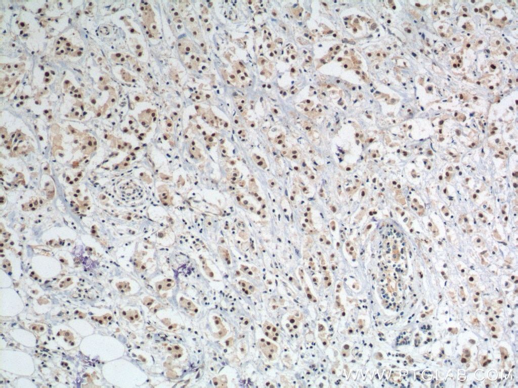 Immunohistochemistry (IHC) staining of human breast cancer tissue using APOBEC3B Polyclonal antibody (14559-1-AP)