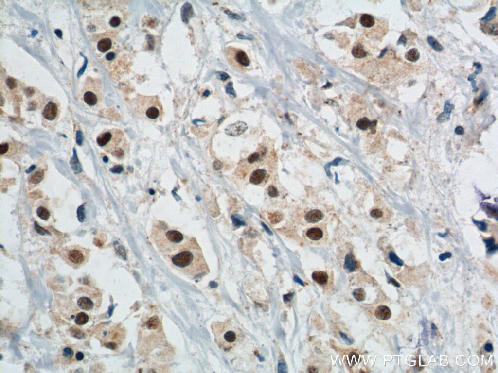 Immunohistochemistry (IHC) staining of human breast cancer tissue using APOBEC3B Polyclonal antibody (14559-1-AP)
