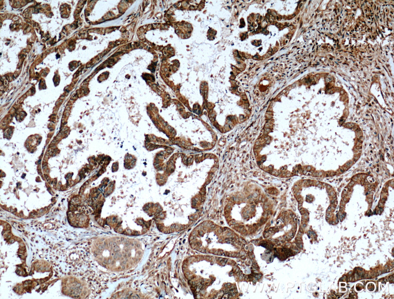 Immunohistochemistry (IHC) staining of human ovary tumor tissue using APOBEC3C Polyclonal antibody (10591-1-AP)