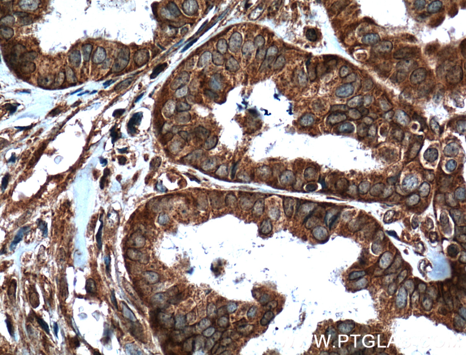 Immunohistochemistry (IHC) staining of human ovary tumor tissue using APOBEC3C Polyclonal antibody (10591-1-AP)