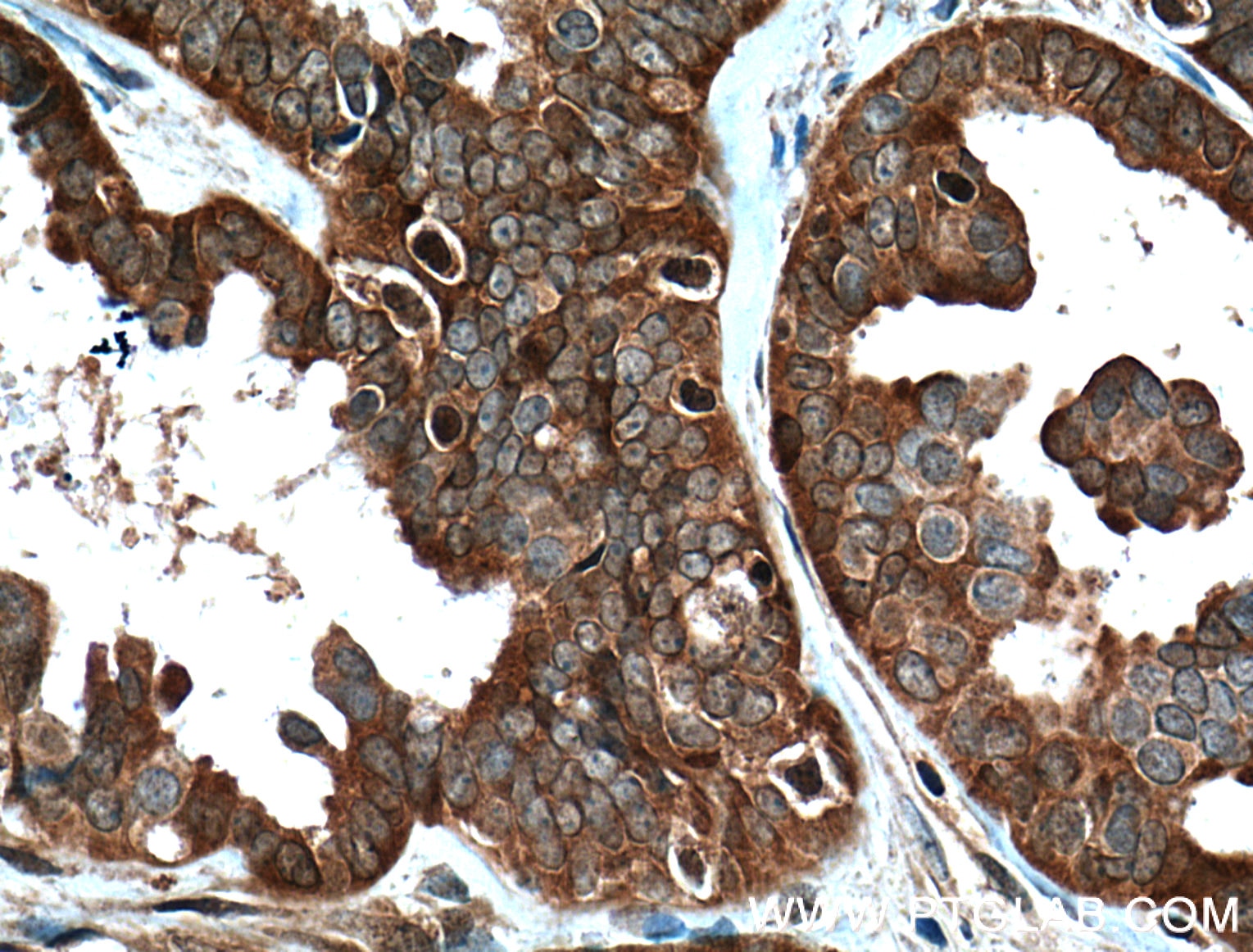 Immunohistochemistry (IHC) staining of human ovary tumor tissue using APOBEC3C Polyclonal antibody (10591-1-AP)