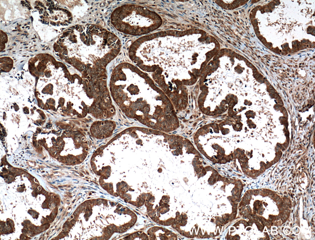 IHC staining of human ovary tumor using 10591-1-AP