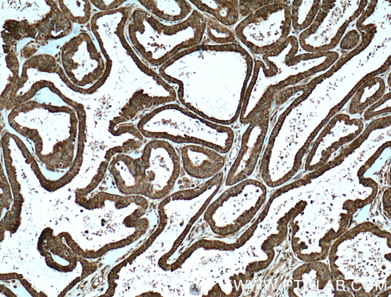 IHC staining of human ovary tumor using 10591-1-AP
