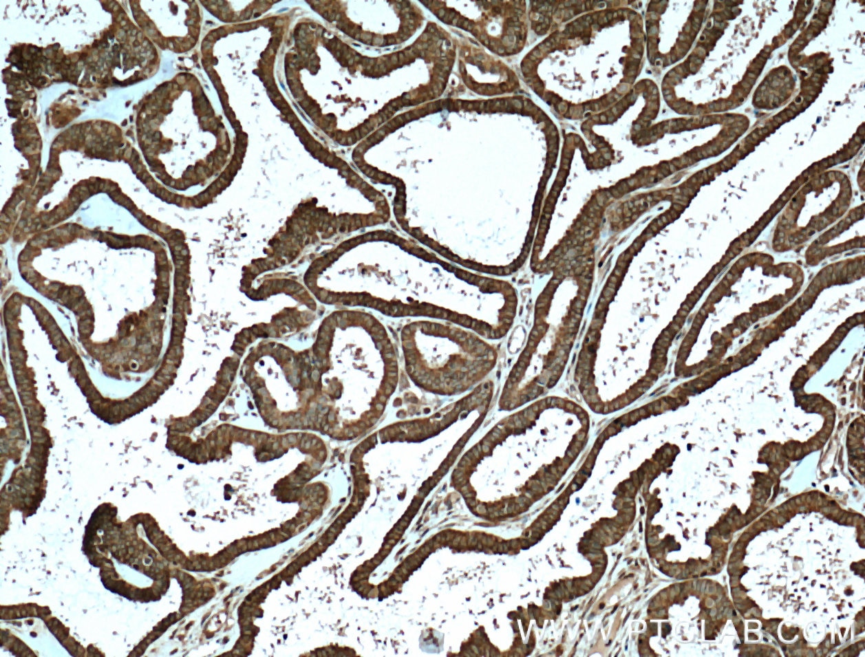 Immunohistochemistry (IHC) staining of human ovary tumor tissue using APOBEC3C Polyclonal antibody (10591-1-AP)