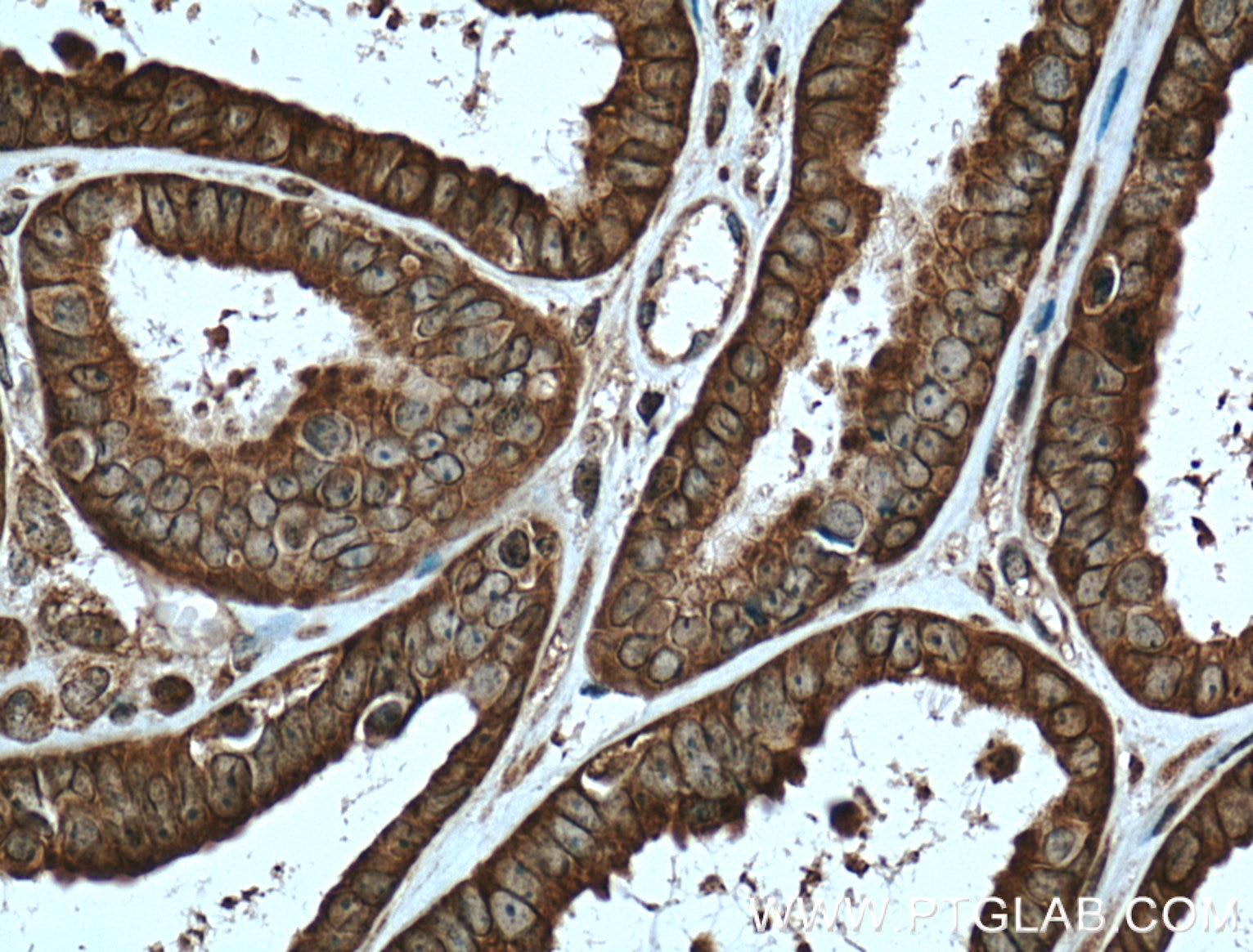 Immunohistochemistry (IHC) staining of human ovary tumor tissue using APOBEC3C Polyclonal antibody (10591-1-AP)