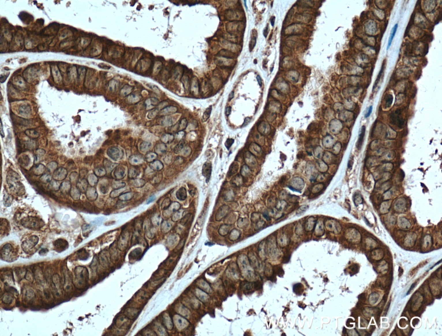 IHC staining of human ovary tumor using 10591-1-AP