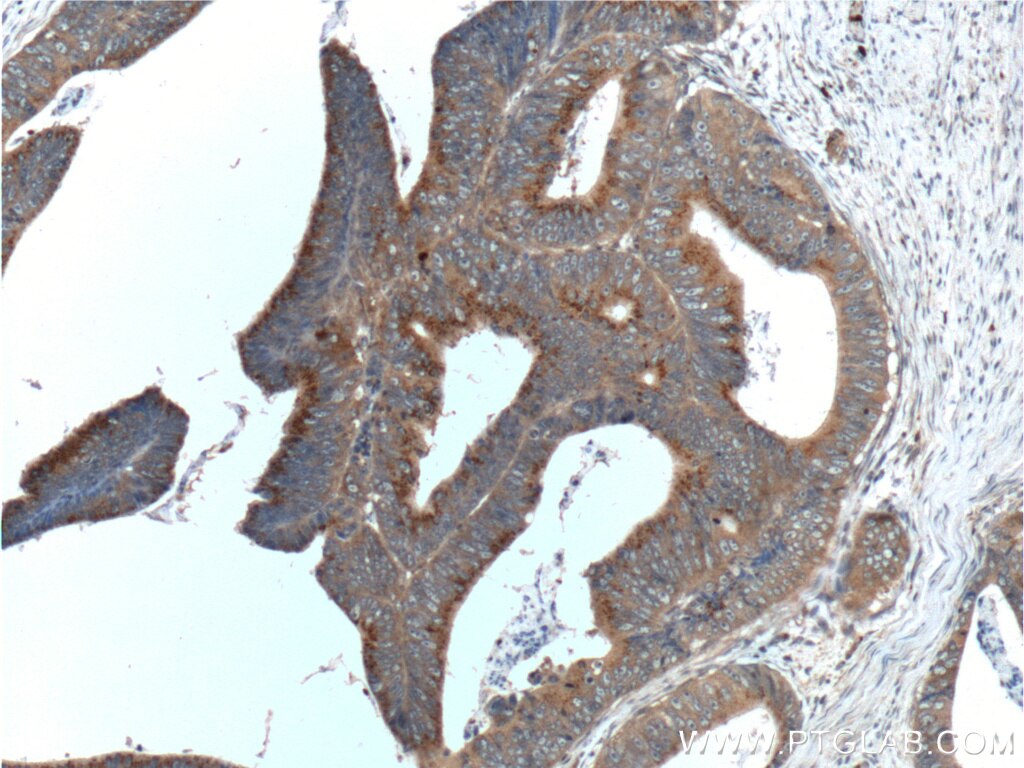 IHC staining of human colon cancer using 10608-1-AP