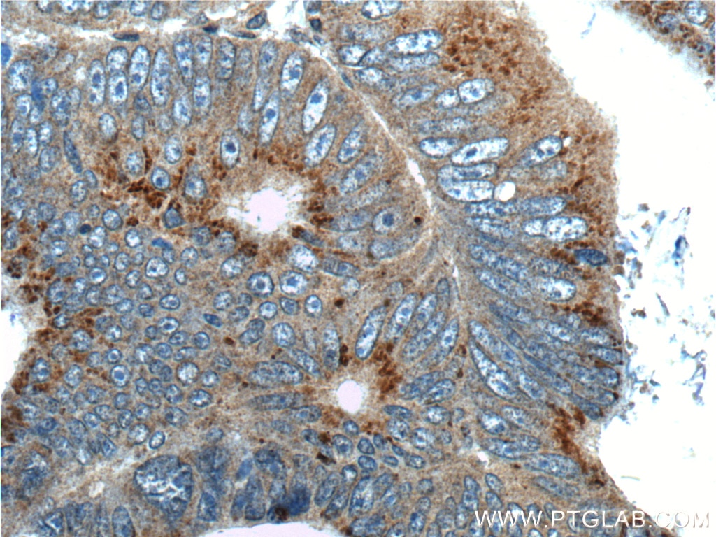 Immunohistochemistry (IHC) staining of human colon cancer tissue using APOBEC3G Polyclonal antibody (10608-1-AP)