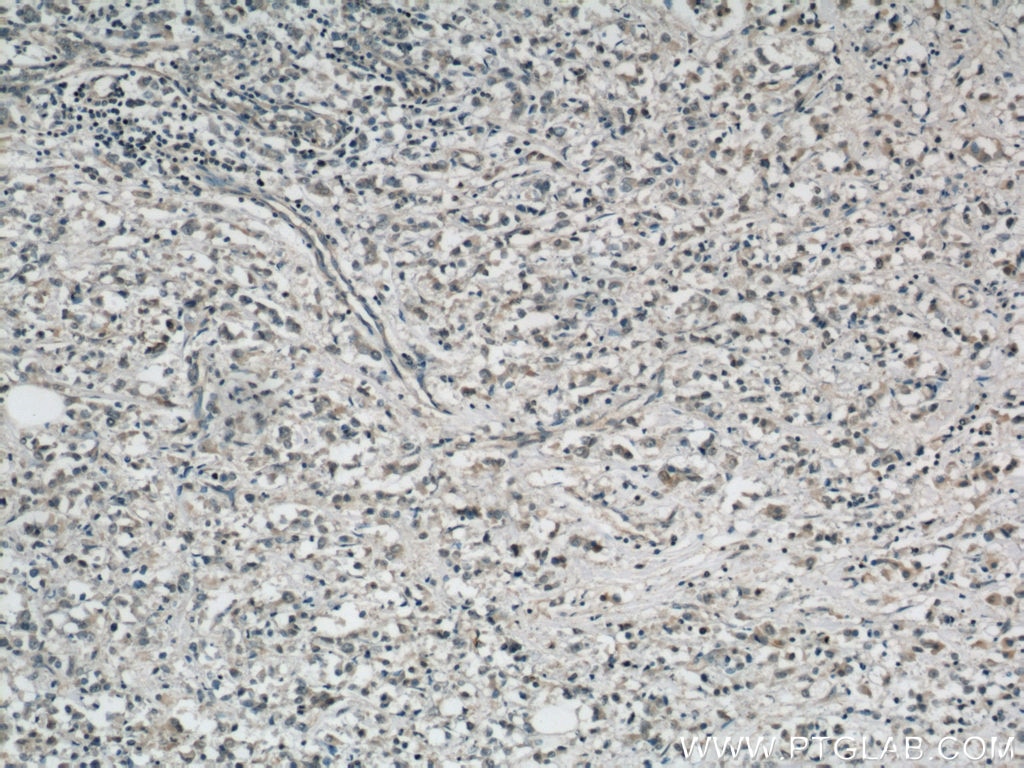 IHC staining of human breast cancer using 60100-1-Ig
