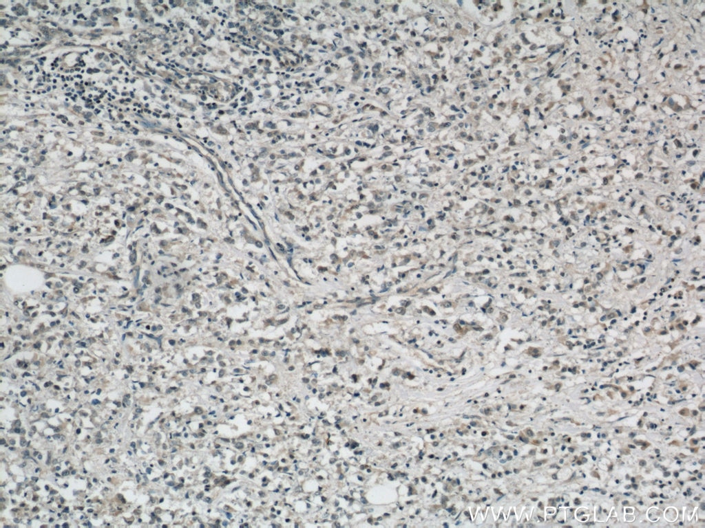 Immunohistochemistry (IHC) staining of human breast cancer tissue using APOBEC3G Monoclonal antibody (60100-1-Ig)