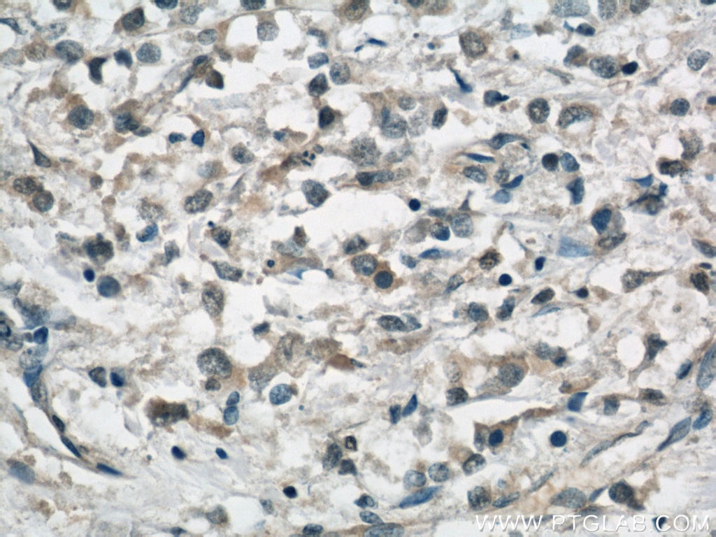 Immunohistochemistry (IHC) staining of human breast cancer tissue using APOBEC3G Monoclonal antibody (60100-1-Ig)