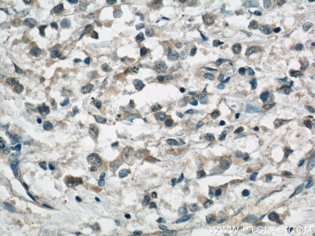 IHC staining of human breast cancer using 60100-1-Ig