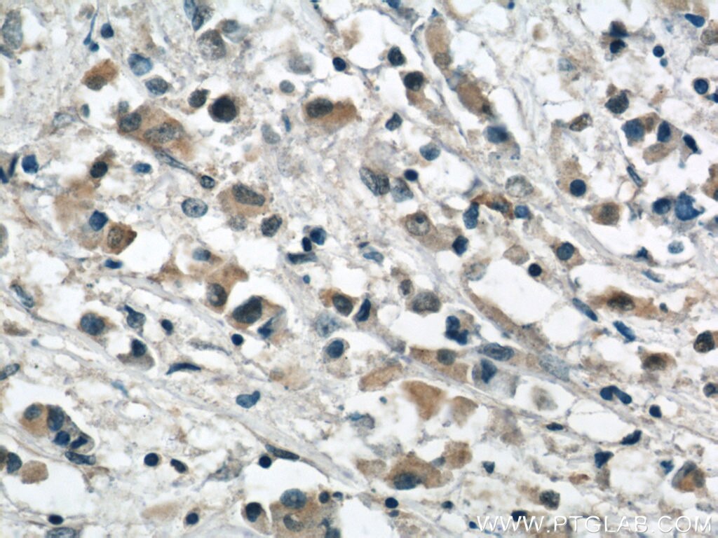 Immunohistochemistry (IHC) staining of human breast cancer tissue using APOBEC3G Monoclonal antibody (60100-1-Ig)