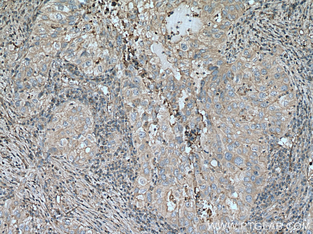 Immunohistochemistry (IHC) staining of human lung cancer tissue using APOC1 Polyclonal antibody (16775-1-AP)