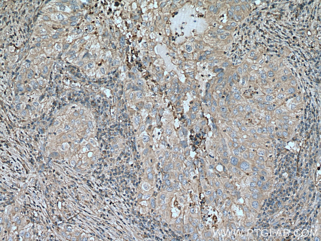 IHC staining of human lung cancer using 16775-1-AP