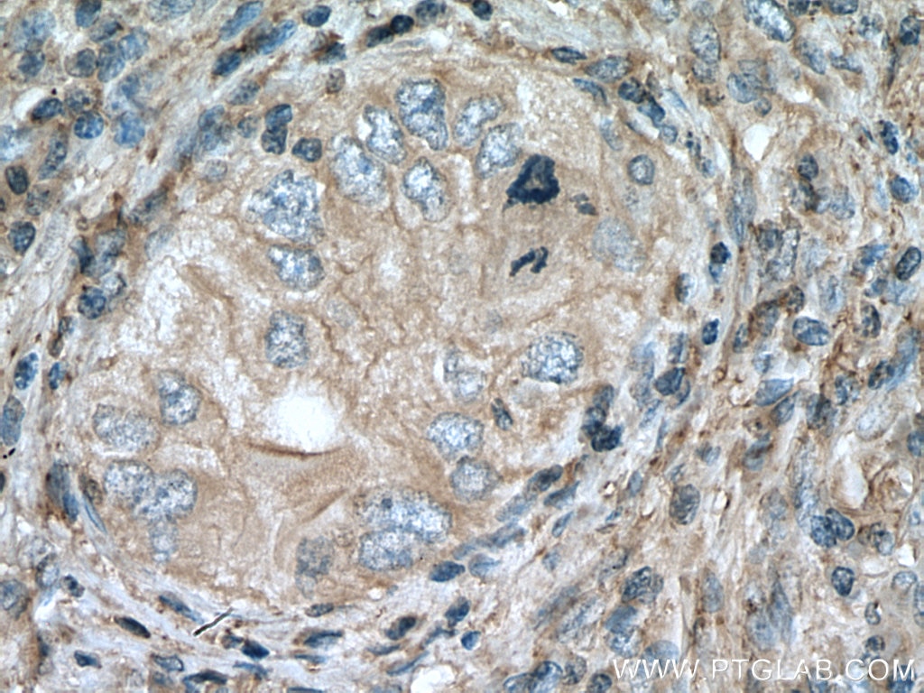 Immunohistochemistry (IHC) staining of human lung cancer tissue using APOC1 Polyclonal antibody (16775-1-AP)