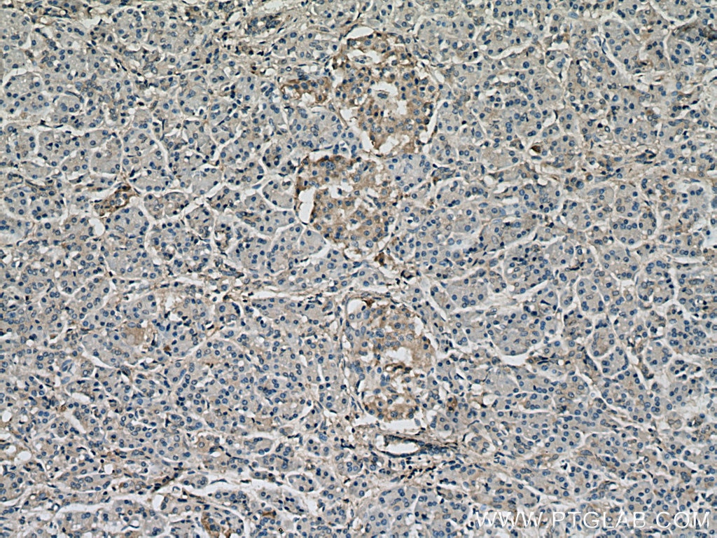 Immunohistochemistry (IHC) staining of human pancreas cancer tissue using APOC1 Polyclonal antibody (16775-1-AP)