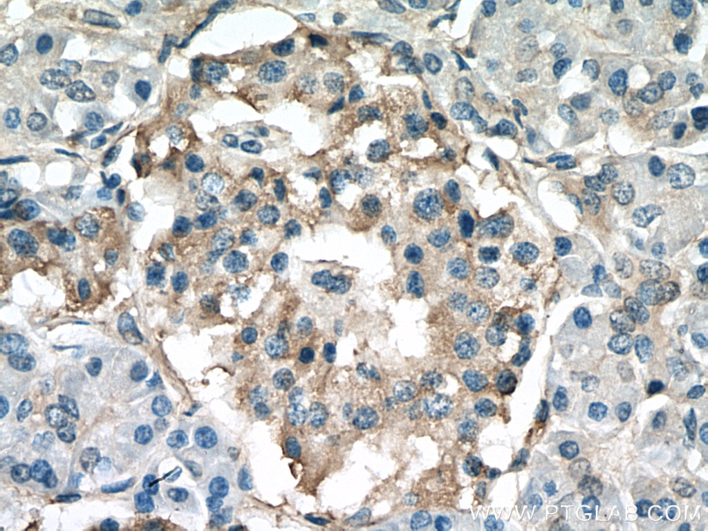 IHC staining of human pancreas cancer using 16775-1-AP
