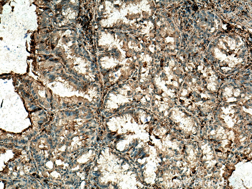 Immunohistochemistry (IHC) staining of human lung cancer tissue using APOC1 Polyclonal antibody (16775-1-AP)