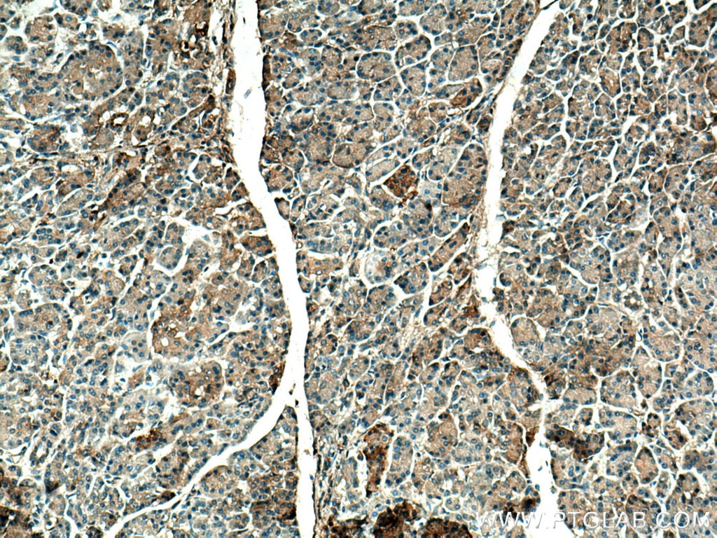 Immunohistochemistry (IHC) staining of human pancreas cancer tissue using APOC1 Polyclonal antibody (16775-1-AP)