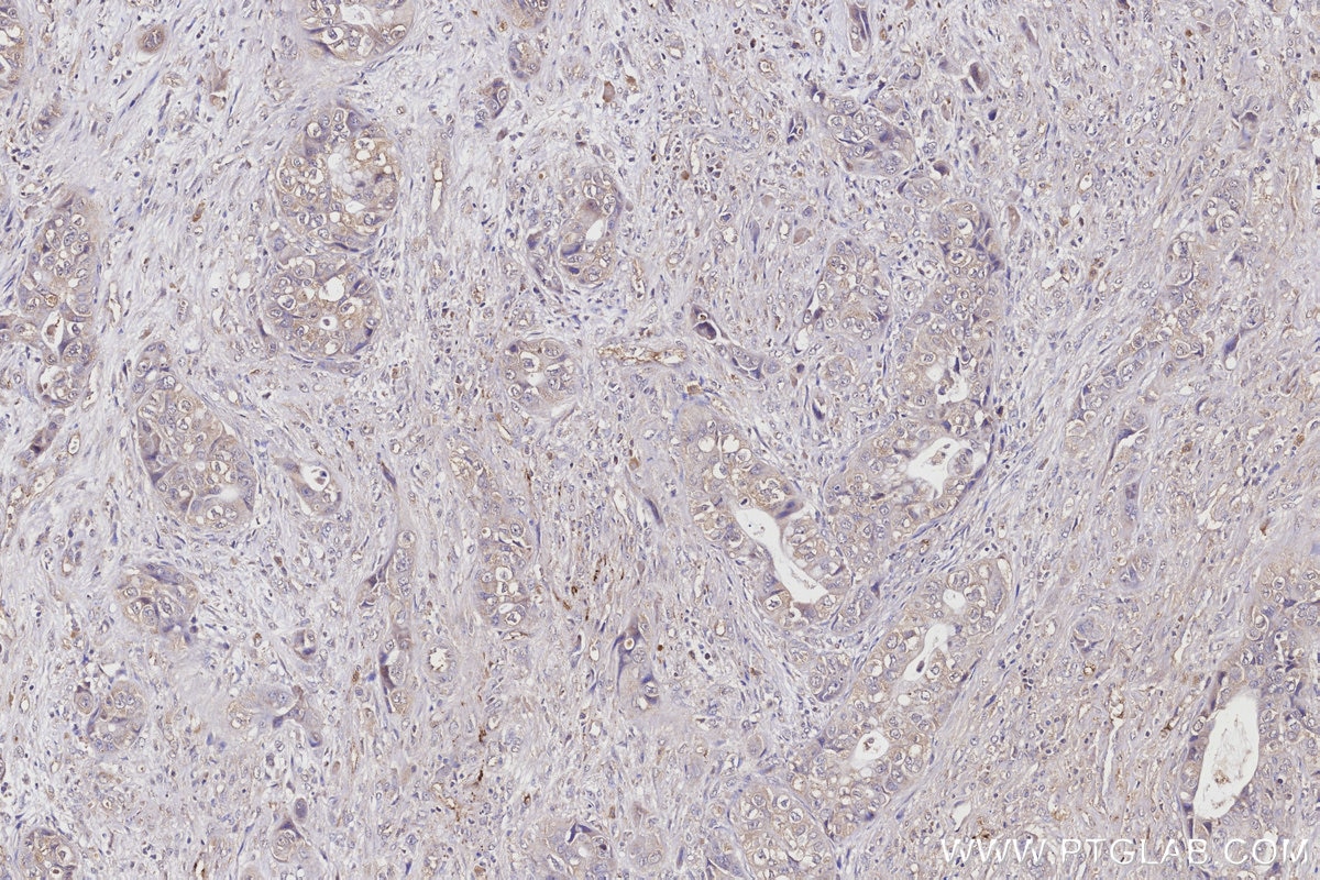 Immunohistochemical analysis of paraffin-embedded human pancreas cancer tissue slide using 66830-1-Ig (APOE antibody) at dilution of 1:1000 (under 10x lens). Heat mediated antigen retrieval with Tris-EDTA buffer (pH 9.0). Immunohistochemistry (IHC) staining of human pancreas cancer tissue using APOE Monoclonal antibody (66830-1-Ig)
