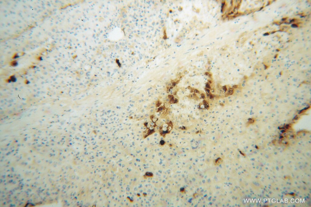 Immunohistochemistry (IHC) staining of human liver cancer tissue using Apolipoprotein H Polyclonal antibody (11892-1-AP)