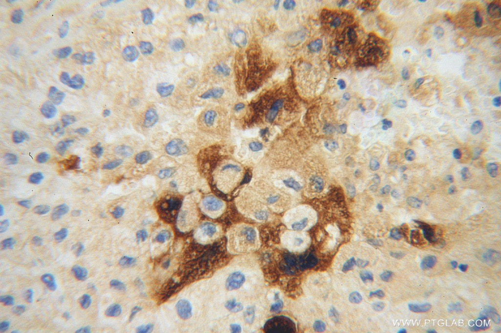 Immunohistochemistry (IHC) staining of human liver cancer tissue using Apolipoprotein H Polyclonal antibody (11892-1-AP)